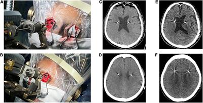 Comparison of dural puncture and dural incision in deep brain stimulation surgery: A simple but worthwhile technique modification